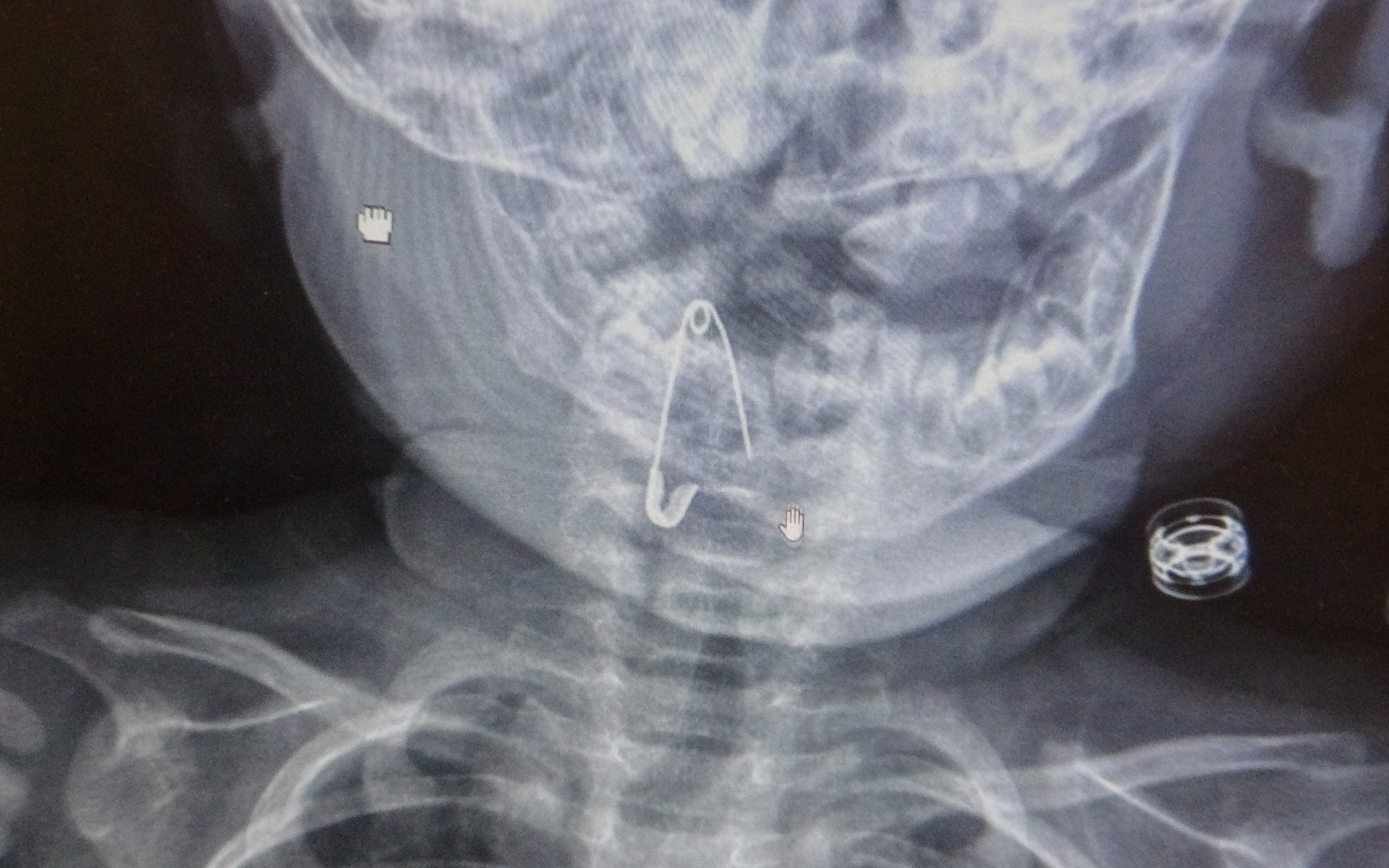 8 aylık bebeğin boğazına kaçan çengelli iğne başarılı bir operasyonla çıkartıldı